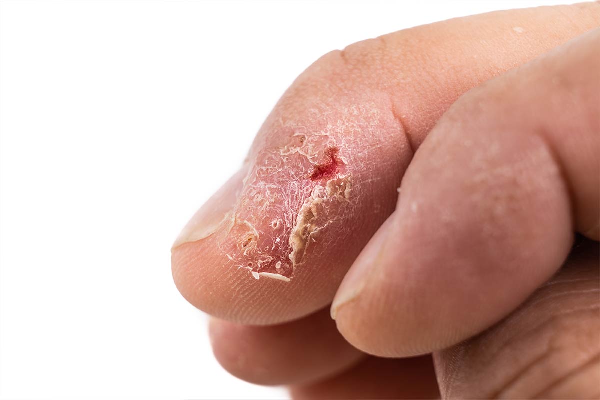 Tratamento para dermatite de unha