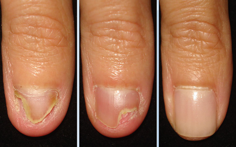 Sintomas de dermatite de unha