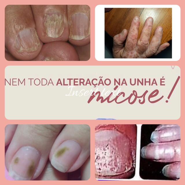 Tratamento para dermatite de unha
