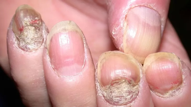 Dermatite de contato em cutículas