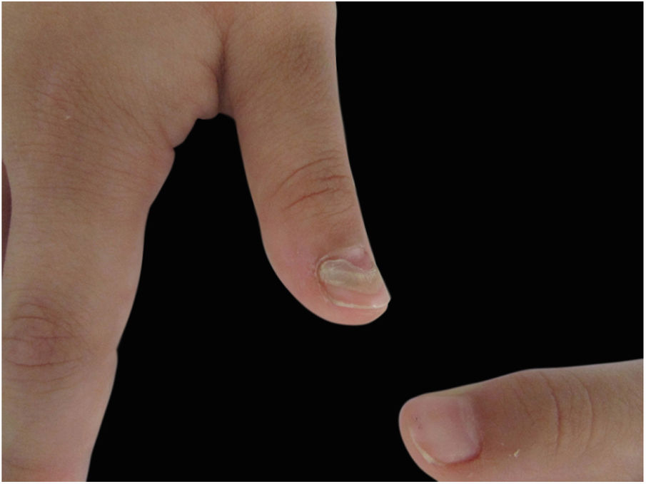 anemia e unhas