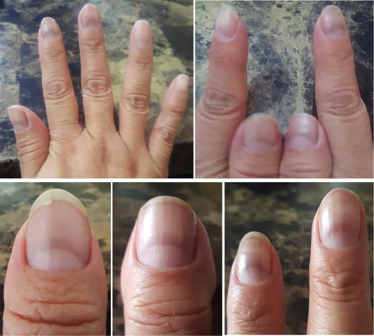 unha amarelada descolada