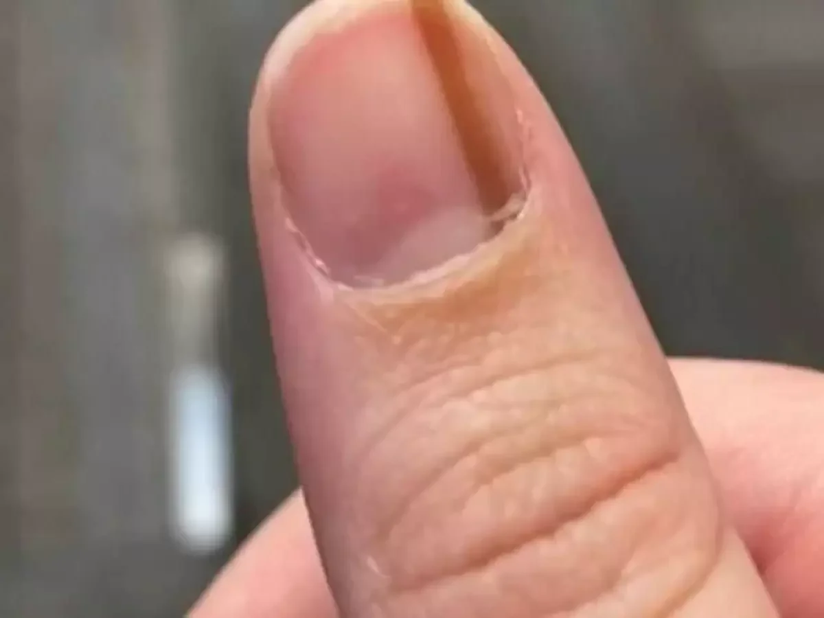 doença na unha da mão