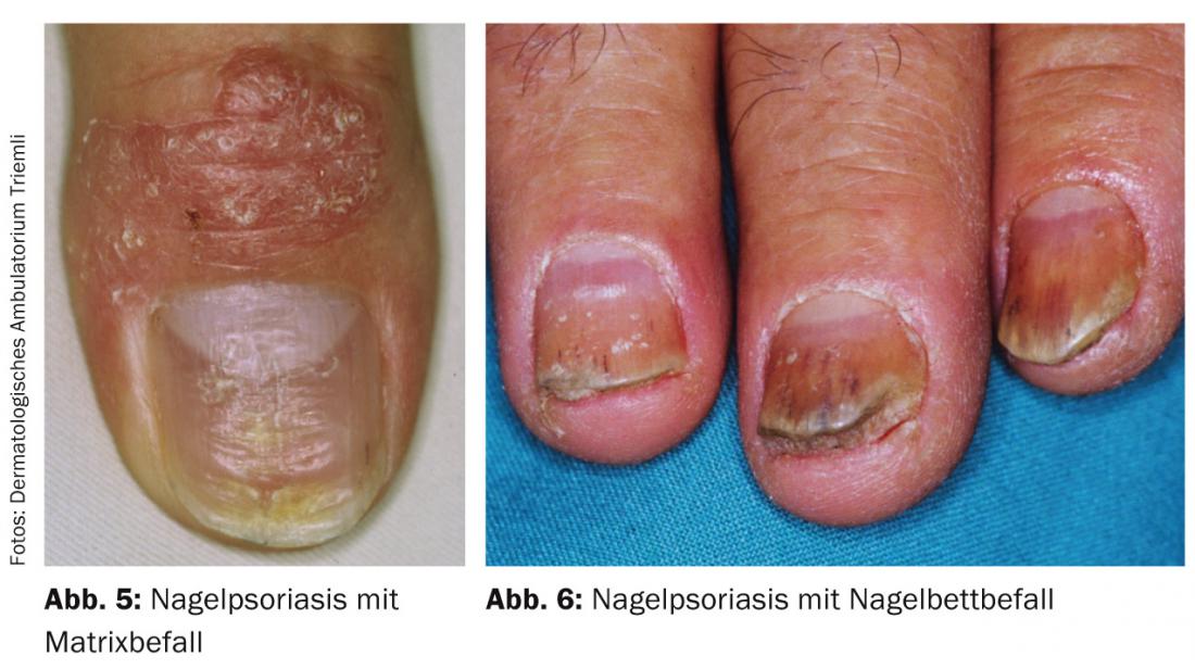 5 ideias de títulos:
1. Unhas Amareladas: O Que Pode Ser e Como Tratar?
2. Dor e Inchaço ao Redor da Unha: Entenda a Paroníquia
3. Linhas Escuras nas Unhas: Sinais de Alerta para o Melanoma
4. Unhas Quebradiças: Causas e Soluções para a Saúde das Unhas
5. Cianose nas Unhas: Indicativo de Problemas Cardíacos ou Respiratórios?