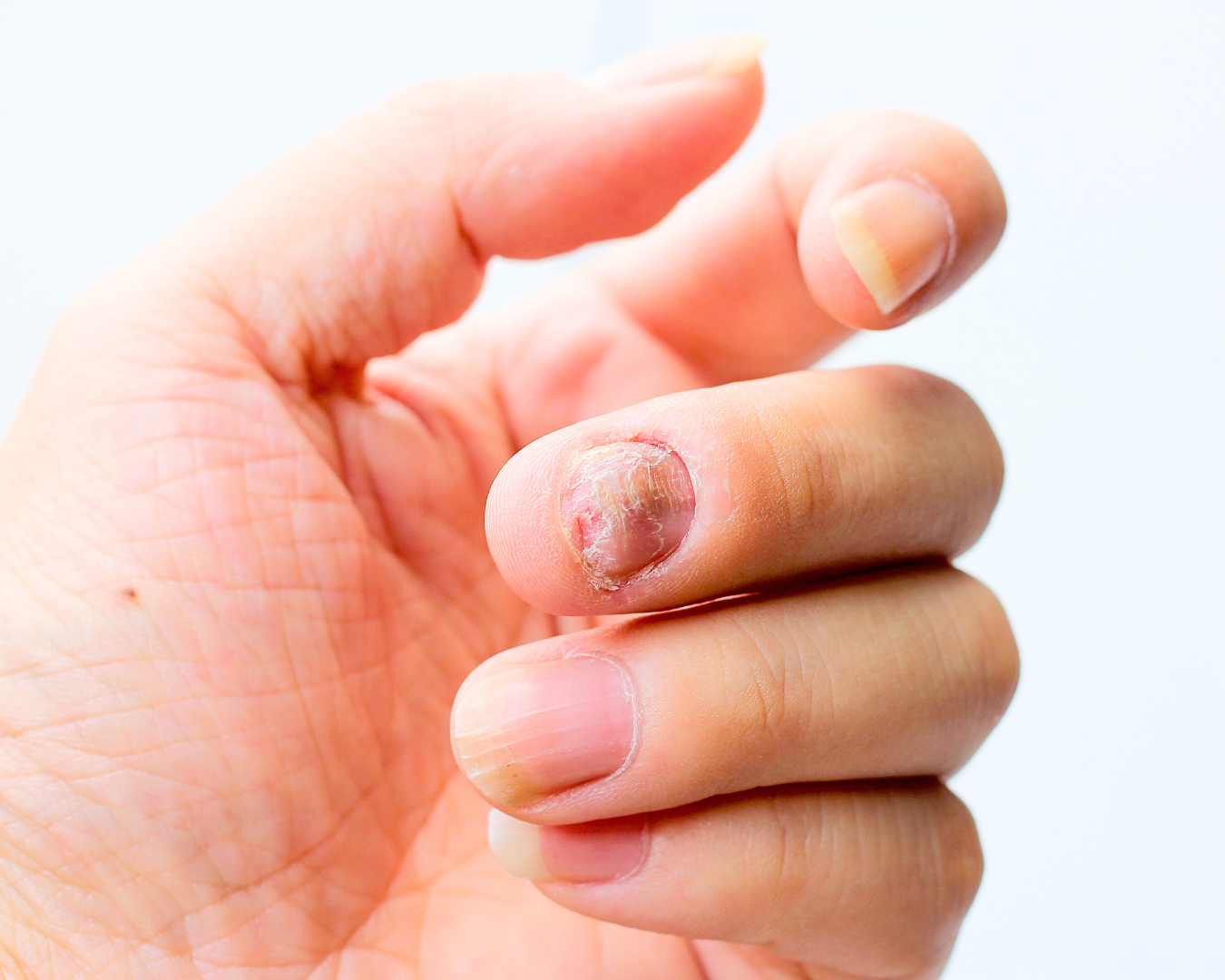 5 ideias de títulos:
1. Unhas Amareladas: O Que Pode Ser e Como Tratar?
2. Dor e Inchaço ao Redor da Unha: Entenda a Paroníquia
3. Linhas Escuras nas Unhas: Sinais de Alerta para o Melanoma
4. Unhas Quebradiças: Causas e Soluções para a Saúde das Unhas
5. Cianose nas Unhas: Indicativo de Problemas Cardíacos ou Respiratórios?