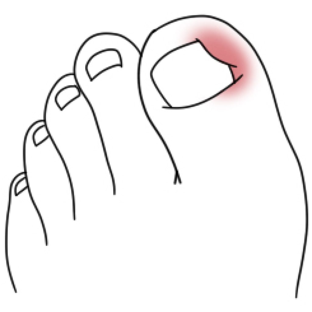 Micose de Unha: Sintomas, Diagnóstico e Opções de Tratamento