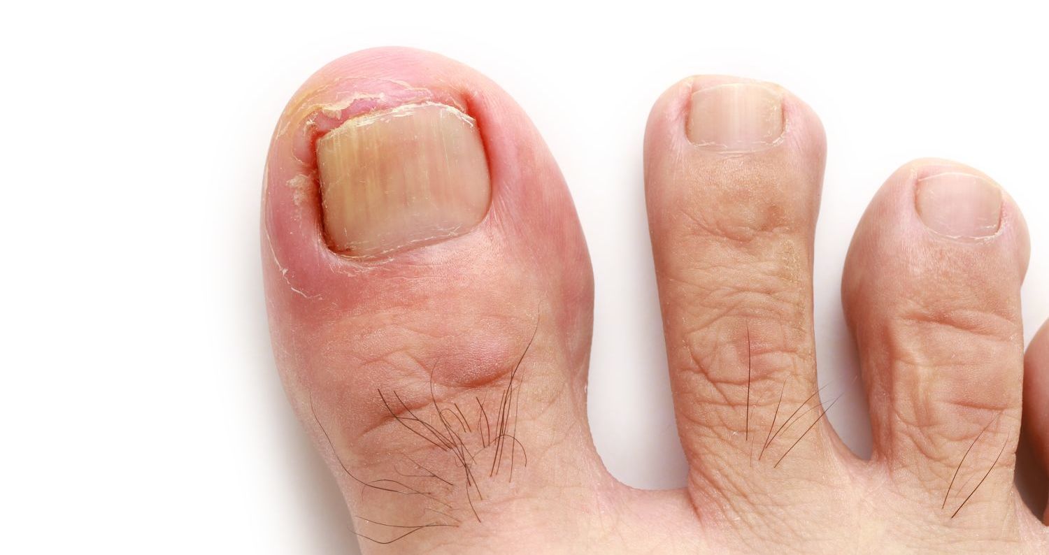 o que fazer quando a unha do pé está doendo muito