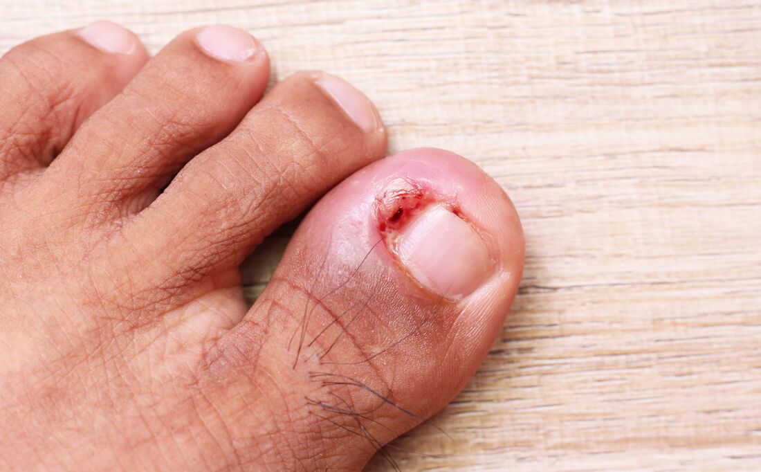 unha do dedão do pé inflamada