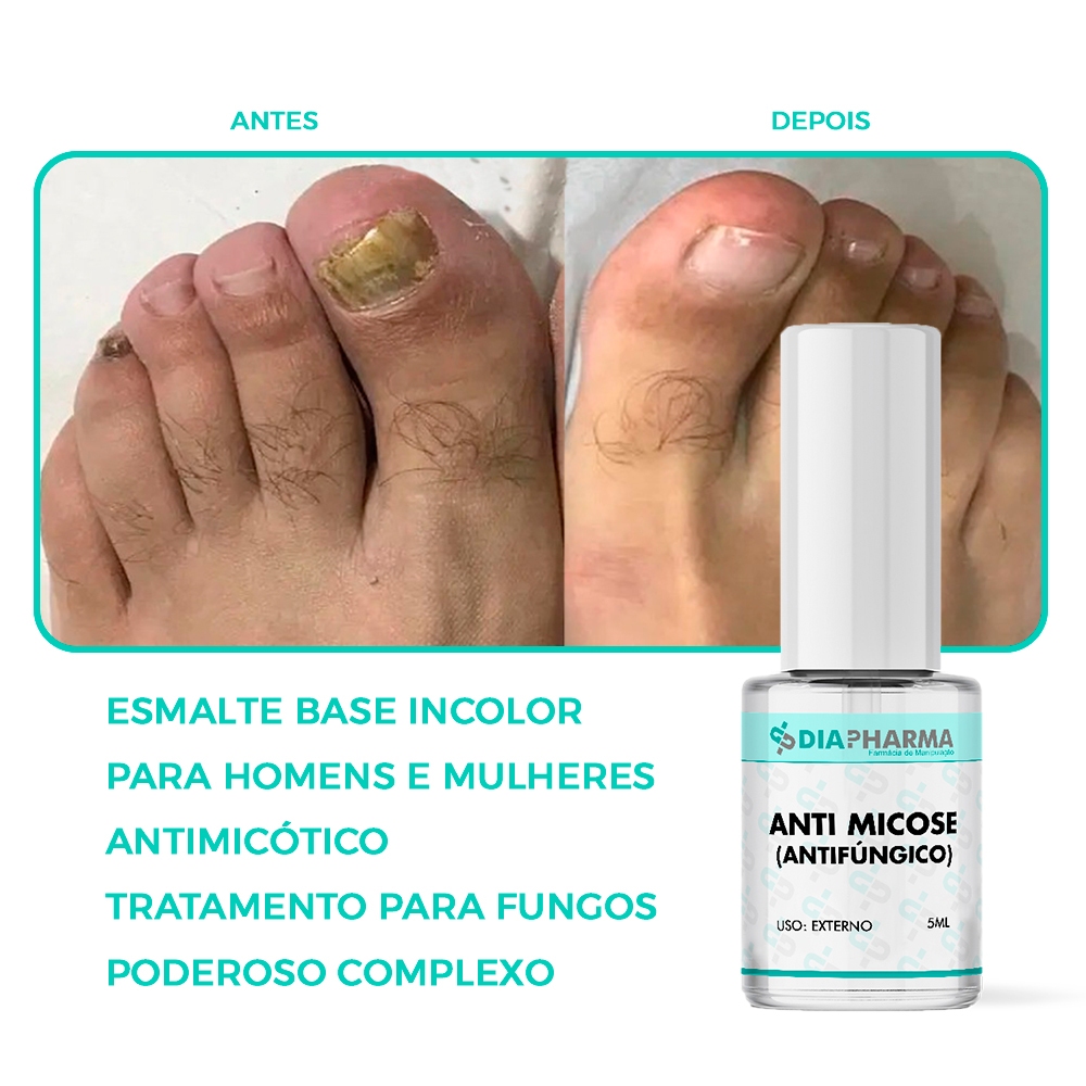 tratamento micose unha esmalte