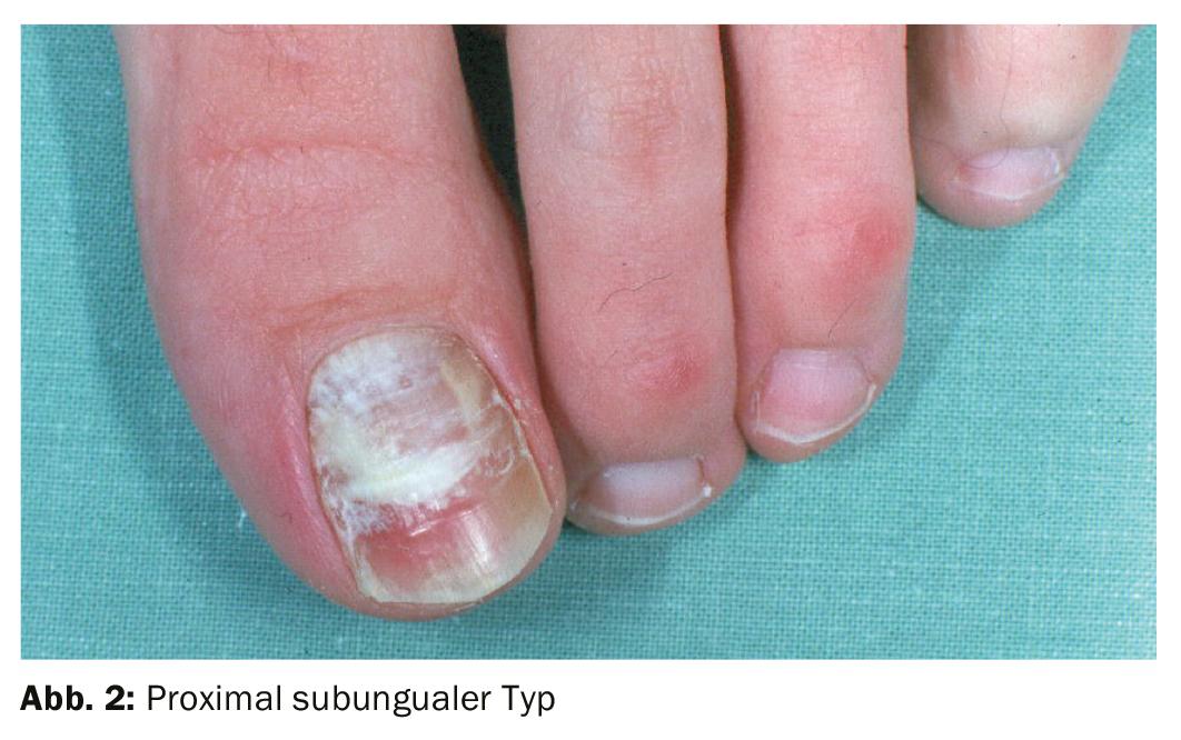 esmalte antifungico vs comprimido para fungo na unha