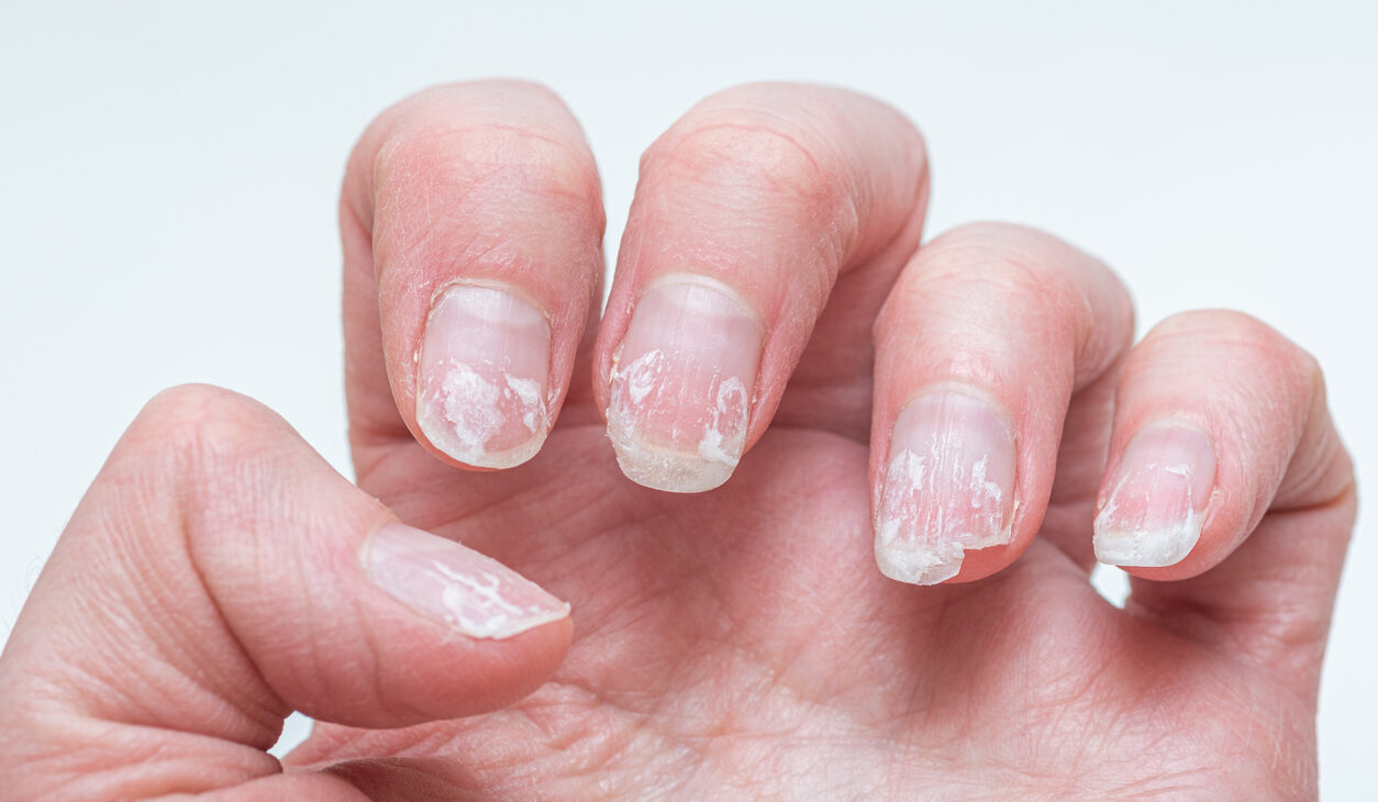 Como Prevenir a Reincidência de Fungos nas Unhas das Mãos