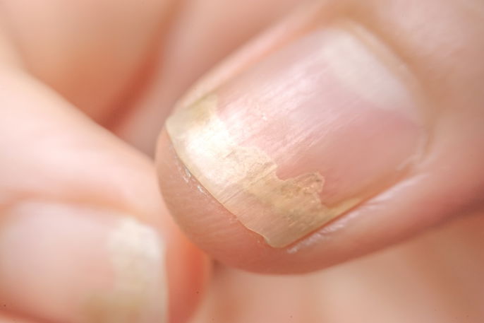 Os 10 Melhores Antifúngicos para Unhas: Guia Completo