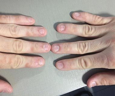 5 ideias de títulos:
1. Onicomicose nas Mãos: Identificando os Primeiros Sinais e Agindo Rápido
2. Micose de Unha Inicial: Guia Completo de Tratamento e Prevenção
3. Fungo na Unha da Mão: Sinais Discretos e Como Tratar Antes que Piora
4. Tratamentos Eficazes para Micose de Unha em Estágio Inicial
5. A Importância do Diagnóstico Precoce da Onicomicose nas Mãos