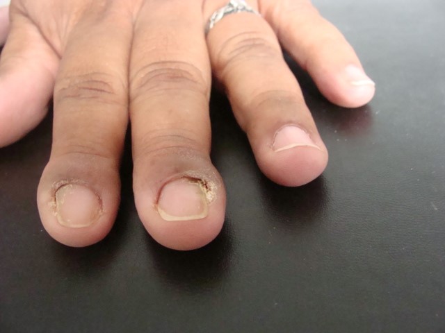 5 ideias de títulos:
1. Onicomicose nas Mãos: Identificando os Primeiros Sinais e Agindo Rápido
2. Micose de Unha Inicial: Guia Completo de Tratamento e Prevenção
3. Fungo na Unha da Mão: Sinais Discretos e Como Tratar Antes que Piora
4. Tratamentos Eficazes para Micose de Unha em Estágio Inicial
5. A Importância do Diagnóstico Precoce da Onicomicose nas Mãos