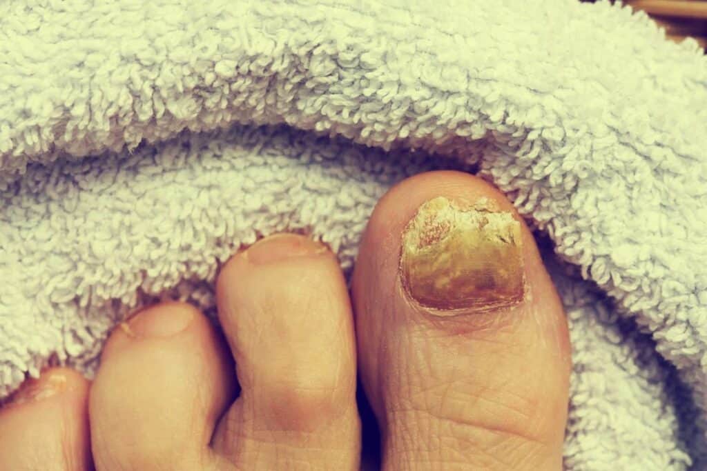 Laser para Fungo na Unha: Uma Opção Eficaz?