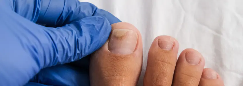 Tratamento Caseiro para Fungo na Unha: Mitos e Verdades