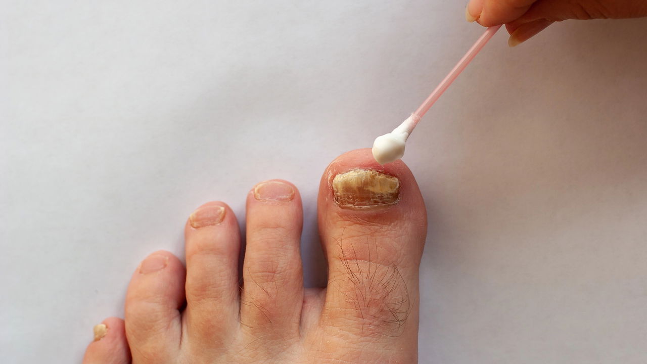Como a Diabetes Afeta a Saúde das Unhas e o Tratamento da Micose
