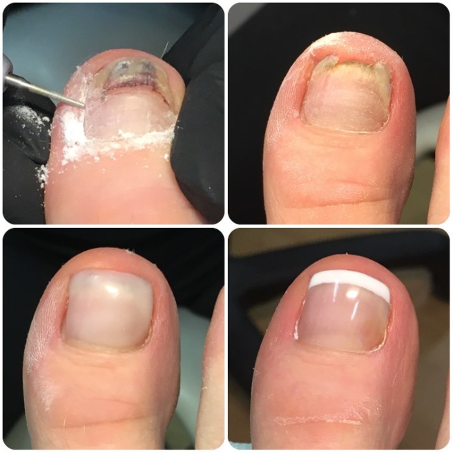 fungo na unha do pé como tratar
