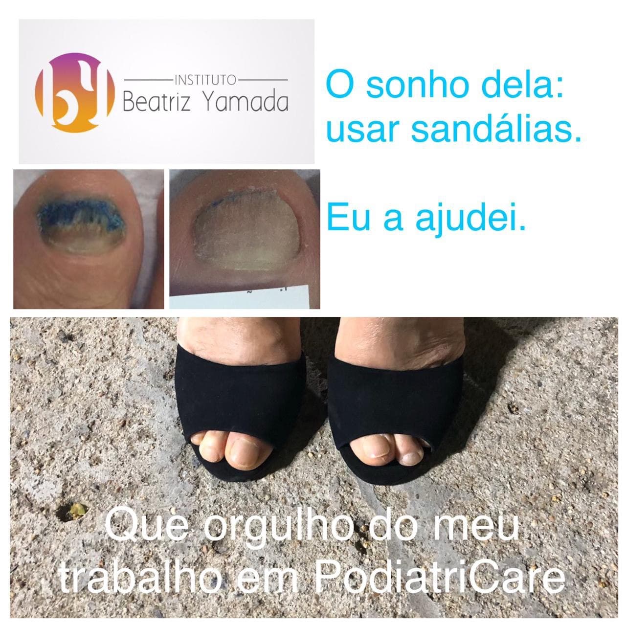 Terapias alternativas e caseiras para complementar o tratamento de fungos nas unhas