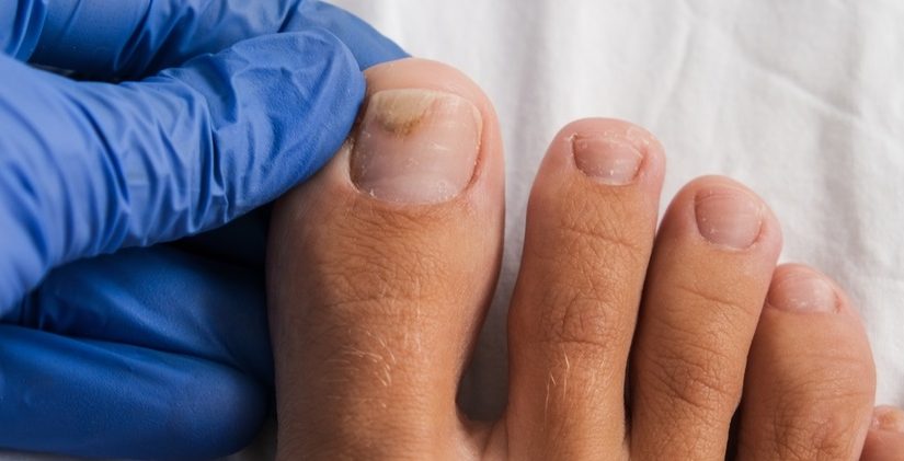 erros comuns ao tratar fungo na unha do pé