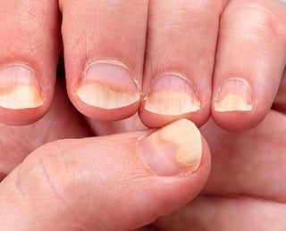 Prevenção da Onicomicose: Dicas Essenciais para Manter Suas Unhas Saudáveis