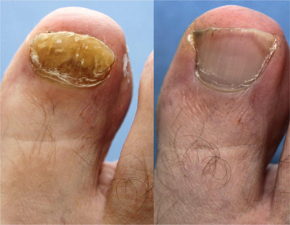 A Relação Entre Diabetes e o Risco Aumentado de Micose de Unha