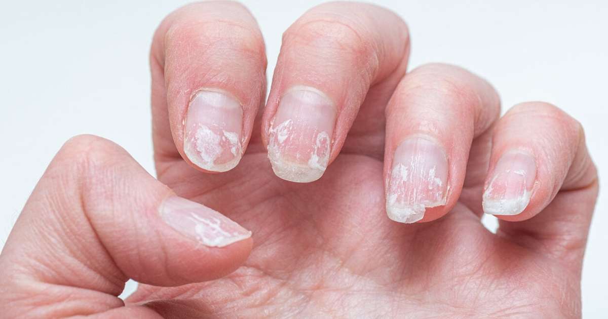 Micose de Unha nas Mãos: Guia Completo de Sintomas e Tratamentos