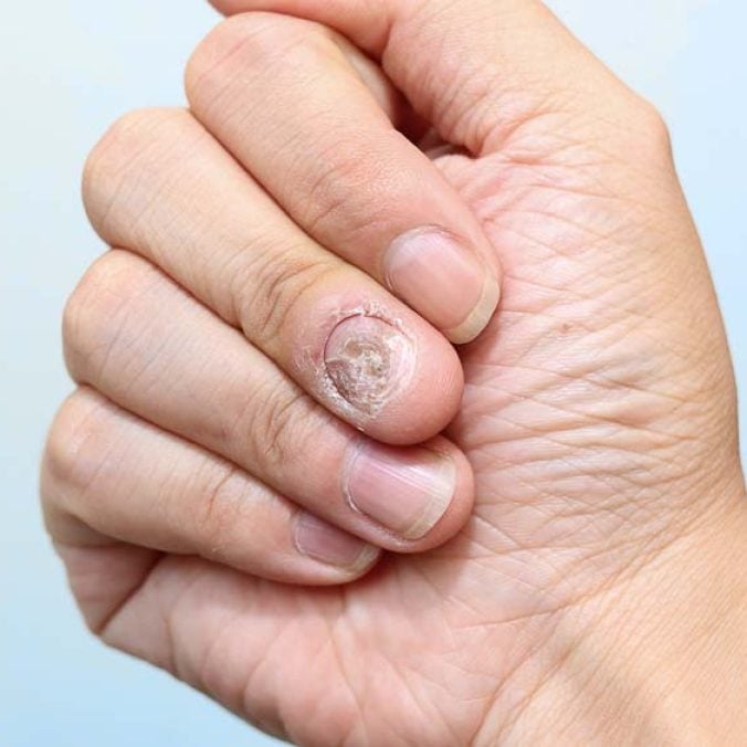 Remédios Caseiros para Micose de Unha: Eficácia e Cuidados