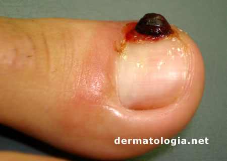 granuloma piogênico unha