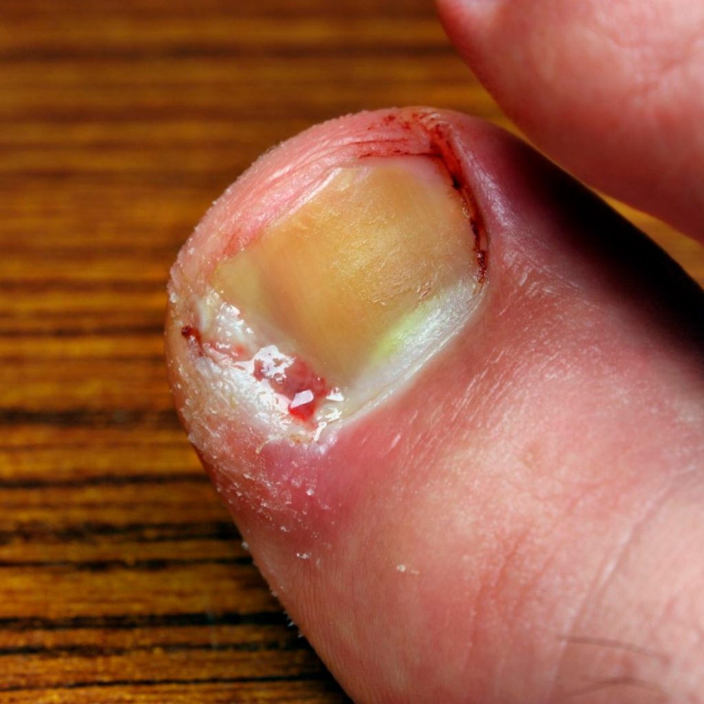 tratamento para carne esponjosa no dedo do pé