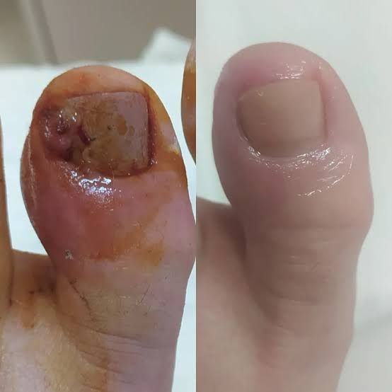 Granuloma Piogênico vs. Melanoma: Como Diferenciar?