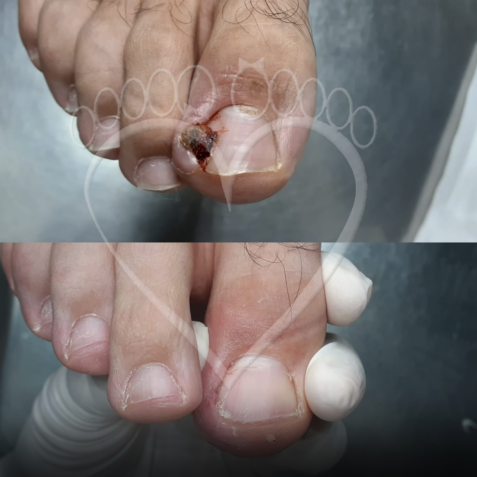 Tratamentos Caseiros para Carne Espongosa: Mitos e Verdades