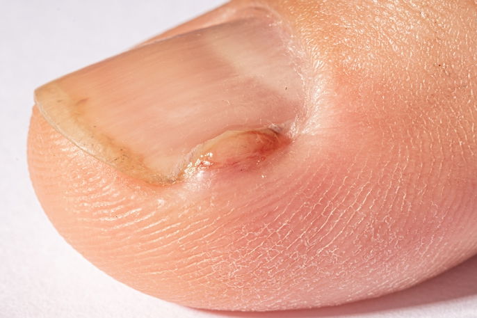 A Importância da Avaliação Dermatológica para Lesões Ungueais