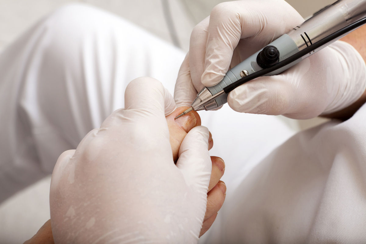 Tratamentos Caseiros para Carne Espongosa: Mitos e Verdades