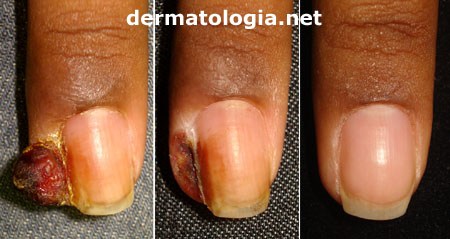 como identificar granuloma na unha precocemente