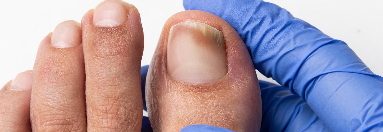 hematoma embaixo da unha