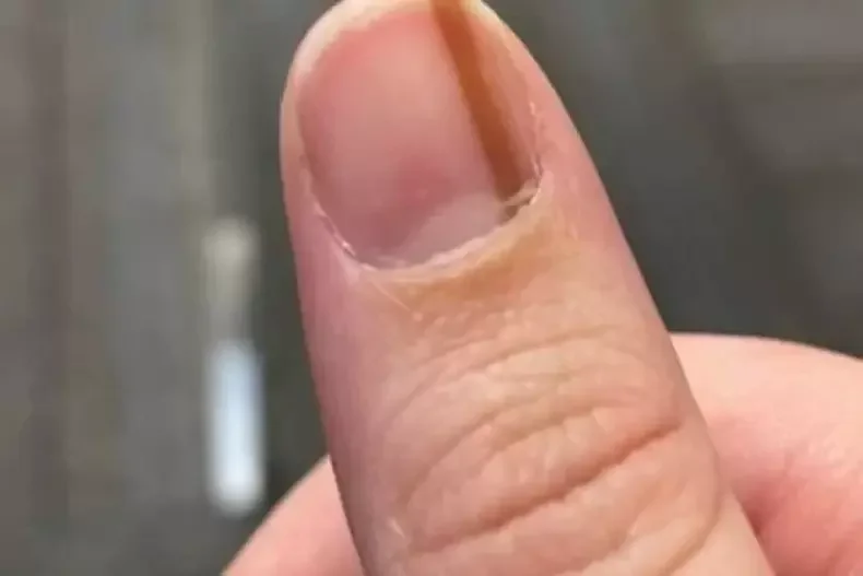 hematoma embaixo da unha