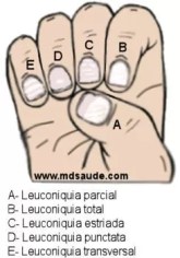 Quando Procurar um Dermatologista: Sinais de Alerta nas Manchas Brancas das Unhas