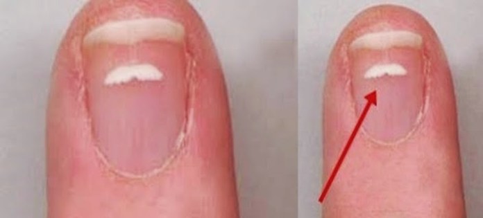 Diferença entre Leuconíquia e Micose: Como Identificar e Tratar Corretamente