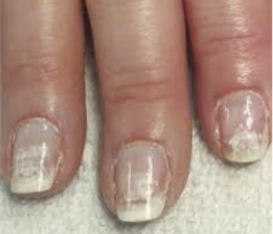 Alimentação e Saúde das Unhas: Nutrientes Essenciais para Prevenir a Leuconíquia