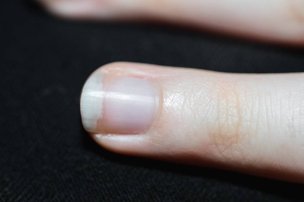 Diferença entre Leuconíquia e Micose: Como Identificar e Tratar Corretamente