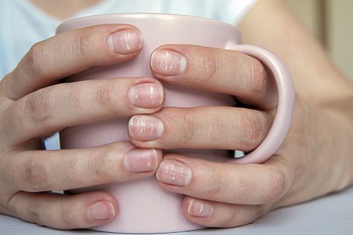 5 ideias de títulos:
1. Leuconíquia: Entenda as Causas e Como Tratar as Manchas Brancas nas Unhas.
2. Unhas com Manchas Brancas: Um Guia Completo de Cuidados e Prevenção.
3. Micoses de Unha: Sintomas