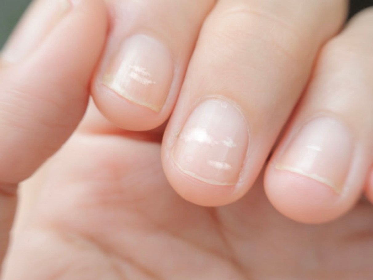 Tratamentos e Como Evitar Infecções.
4. Deficiências Nutricionais e a Saúde das Unhas: O Que Você Precisa Saber.
5. Traumas e Ressecamento: Como o Estilo de Vida Afeta a Aparência das Suas Unhas.