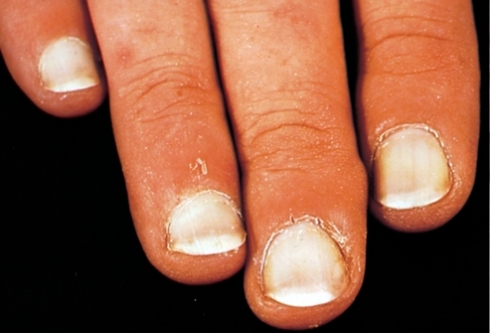 5 ideias de títulos:
1. Leuconíquia: Entenda as Causas e Como Tratar as Manchas Brancas nas Unhas.
2. Unhas com Manchas Brancas: Um Guia Completo de Cuidados e Prevenção.
3. Micoses de Unha: Sintomas
