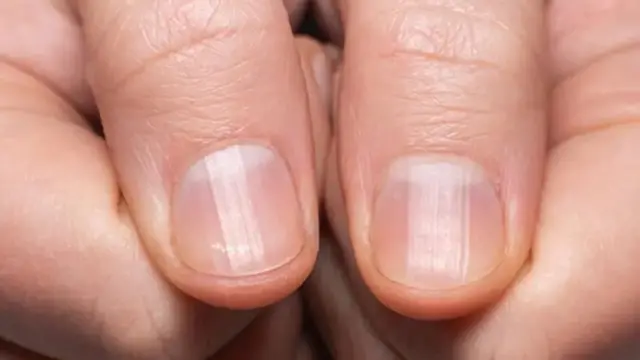 Tratamentos e Como Evitar Infecções.
4. Deficiências Nutricionais e a Saúde das Unhas: O Que Você Precisa Saber.
5. Traumas e Ressecamento: Como o Estilo de Vida Afeta a Aparência das Suas Unhas.