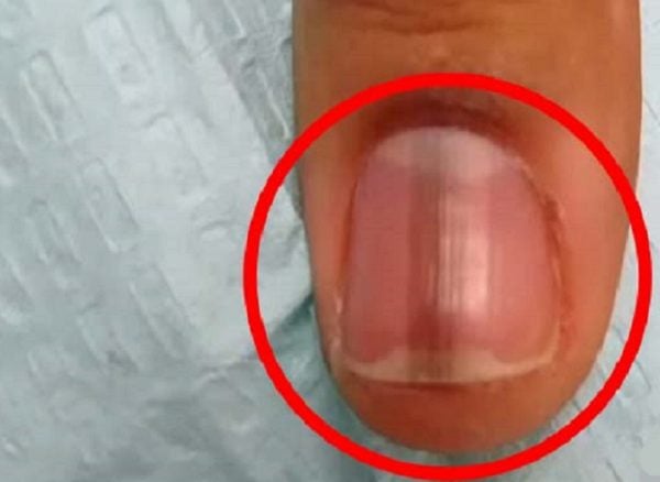 Melanoma Subungueal: Sinais de Alerta e a Importância do Diagnóstico Precoce