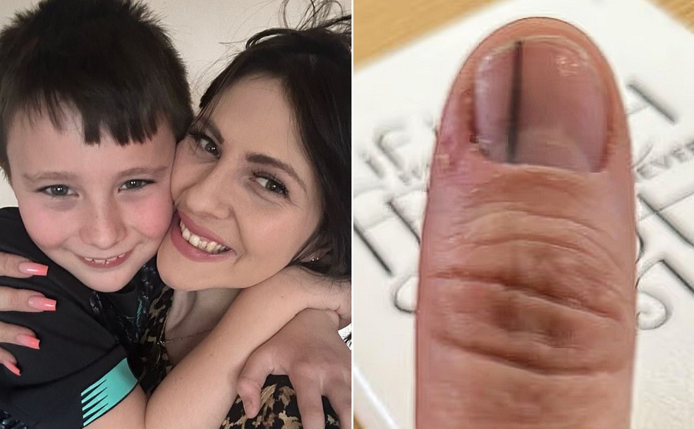 Saúde das Unhas: Prevenção e Cuidados para Evitar Manchas Escuras