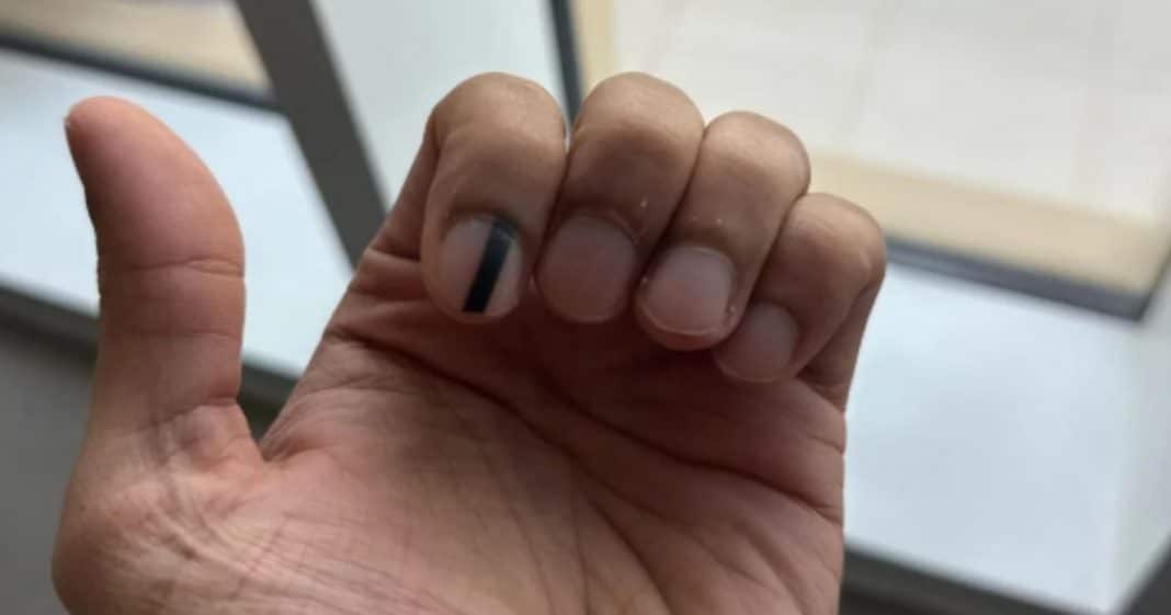 Melanoma Subungueal: Sinais de Alerta e a Importância do Diagnóstico Precoce