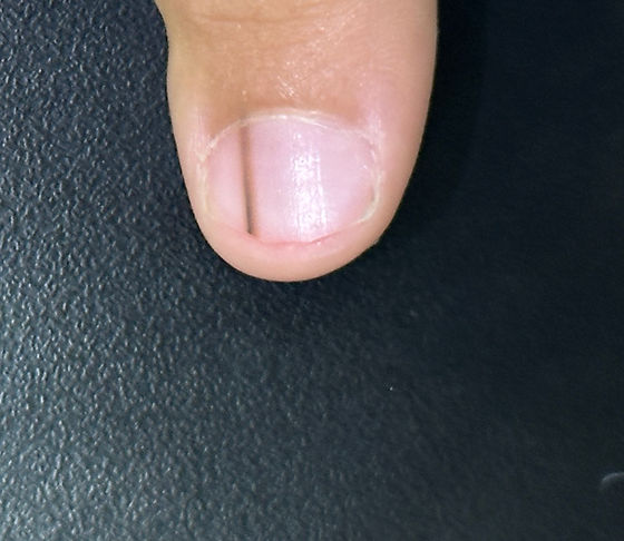 Saúde das Unhas: Prevenção e Cuidados para Evitar Manchas Escuras