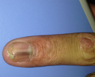 Melanoma Subungueal: Sinais de Alerta e a Importância do Diagnóstico Precoce